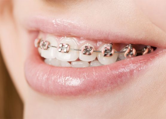 Fikadental boca con Brackets